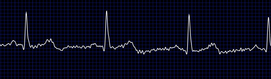 ekg (2)