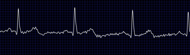 ekg (2)